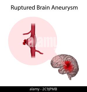 Aneurysma des gebrochenen Gehirns, Illustration. Ein Aneurysma ist eine blutgefüllte Dilatation in einem Blutgefäß. Stockfoto