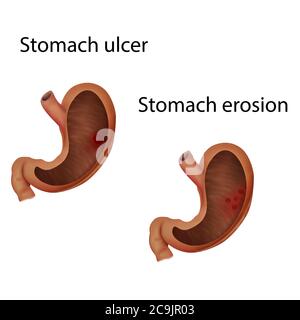 Magengeschwür und Magenerosion, Illustration. Stockfoto