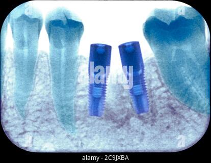 Zahnimplantate nach Zahnextraktion, farbiges Röntgen. Während dieser Operation werden Zahnpfosten (dunkelblau, Mitte) in den Kieferknochen gelegt, um zu ermöglichen Stockfoto