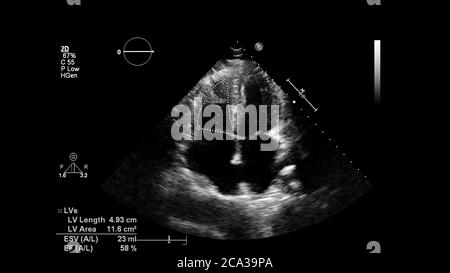 Bild des Herzens im Graustufenmodus während des transösophagealen Ultraschalls. Stockfoto