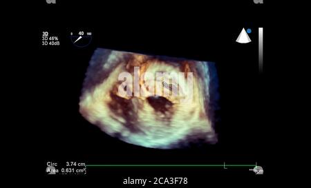 3D-Bild des Herzens während der transösophagealen Ultraschall des Herzens. Stockfoto