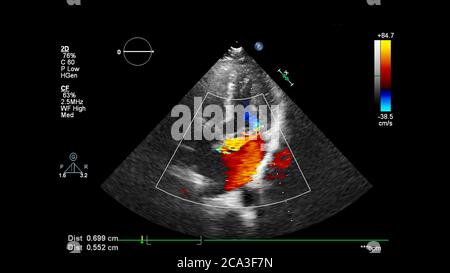 Bild des Herzens während des transösophagealen Ultraschalls mit Doppler-Modus. Stockfoto