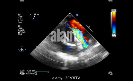 Bild des Herzens während des transösophagealen Ultraschalls mit Doppler-Modus. Stockfoto