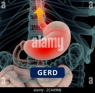 Saurer Rückfluss, GERD. Gastroösophageale Refluxkrankheit. Magen und Verdauung. Menschliche Anatomie. 3d-Illustration Stockfoto