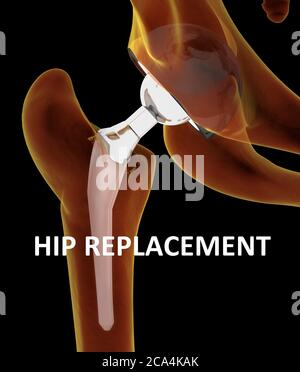 Medizinisch genaue Darstellung des Hüftgelenkersatzes. 3d-Illustration. Stockfoto