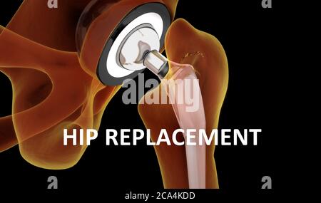 Medizinisch genaue Darstellung des Hüftgelenkersatzes. 3d-Illustration. Stockfoto