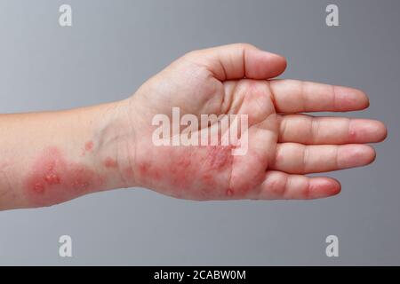 Gürtelrose, Zoster oder Herpes Zoster Symptome am Arm Stockfoto