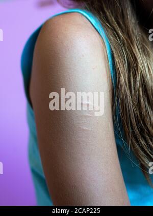 Junge Womans Arm zeigt Narben von selbst Verstümmelung, auf einfachem Hintergrund Selbstschaden. Raum für Text. Stockfoto