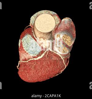Draufsicht auf CTA Koronararterie 3D-Rendering-Bild isoliert o schwarzen Hintergrund für die Suche nach koronarer Herzkrankheit.Clipppig Pfad. Stockfoto