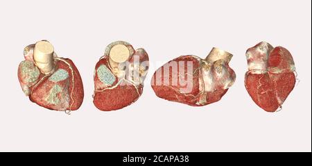 Sammlung von CTA Koronararterie 3D Rendering Bild isoliert o weißen Hintergrund für die Suche nach koronarer Herzkrankheit.Clipppig Pfad. Stockfoto