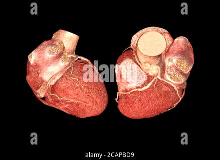 Laterale Anzeige Draufsicht auf CTA Koronarararterie 3D-Rendering-Bild isoliert auf schwarzem Hintergrund für die Suche nach koronarer Herzkrankheit. Stockfoto