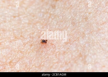 Castor Bean Tick (Ixodes ricinus), ticken auf der menschlichen Haut Stockfoto