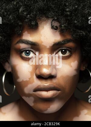 Porträt einer afroamerikanischen Frau mit Vitiligo Haut. Spezielle Haut mit Depigmentierung wegen Melanin verlieren. Konzept von Hautpflege und Gesundheit, Inklusion und Vielfalt, Mode und Schönheit. Stockfoto