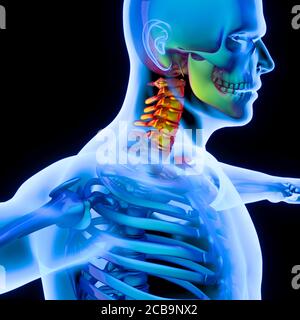 Entzündung der Wirbelsäule zu den Halswirbeln, steifer Hals. 3d-Rendering. Stockfoto