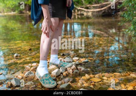 Junge Frau kratzt ihr Bein wegen Insektenstich in der Natur. Bein mit einem Ausschlag bedeckt. Im Hintergrund Bäume und Fluss. Insektenschutzkonzept. Clos Stockfoto