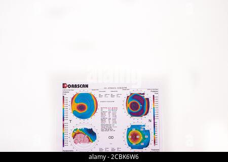 25.07.2020, Zarorizhzhya. Topographie der Hornhaut des Auges, Layout. Keratokonus des rechten Auges ist 3. Grad und das linke Auge ist 2 Grad. Stockfoto