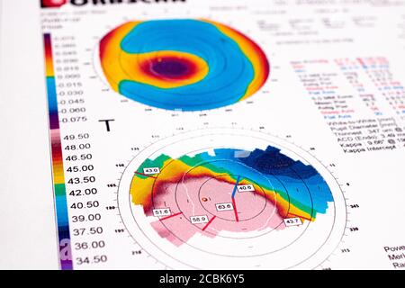 25.07.2020, Zarorizhzhya. Topographie der Hornhaut des Auges, Layout. Keratokonus des rechten Auges ist 3. Grad und das linke Auge ist 2 Grad. Stockfoto