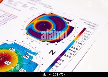 25.07.2020, Zarorizhzhya. Topographie der Hornhaut des Auges, Layout. Keratokonus des rechten Auges ist 3. Grad und das linke Auge ist 2 Grad. Stockfoto
