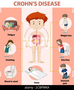 Medizinische Infografik zur Illustration der Morbus Crohn Stock Vektor