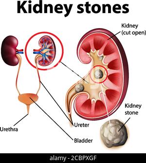 Informative Illustration von Nierensteinen Illustration Stock Vektor