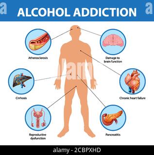 Informationen zur Alkoholabhängigkeit oder Alkoholismus Infografik Illustration Stock Vektor