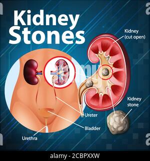 Informative Illustration von Nierensteinen Illustration Stock Vektor