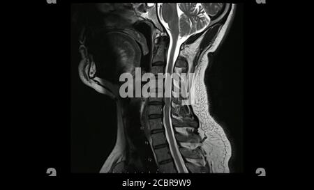 Magnetresonanzbilder der Halswirbelsäule sagittale T2-gewichtete Bilder (MRT-Halswirbelsäule) mit mehreren Bandscheibenerkrankungen, deutlicher bei der C5-6-Bandscheibe. Stockfoto