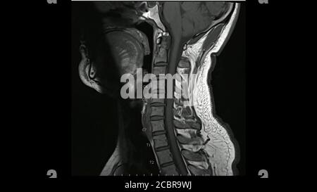 Magnetresonanzbilder der Halswirbelsäule sagittale T1-gewichtete Bilder (MRT-Halswirbelsäule) mit mehreren Bandscheibenerkrankungen, deutlicher bei der C5-6-Bandscheibe. Stockfoto