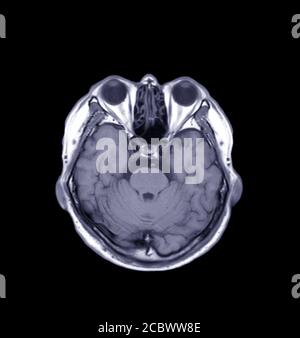 MRT des Gehirns Axiale T1-Ansicht zur Detektion einer Vielzahl von Bedingungen des Gehirns wie Zysten, Tumoren, Blutungen isoliert auf schwarzem Backgroud , Bleedin Stockfoto