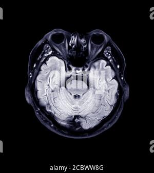 MRT des Gehirns Axial T2 Flair Ansicht für erkennen eine Vielzahl von Bedingungen des Gehirns wie Zysten, Tumoren, Blutungen isoliert auf schwarzem Hintergrund , Stockfoto