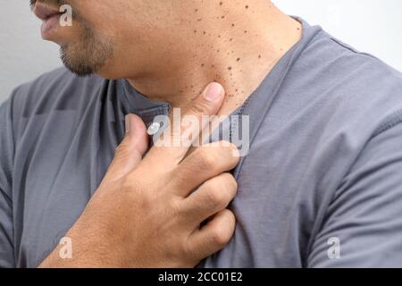 Closed up die Haut-Tags oder Acrochordon am Hals Mann auf weißem Hintergrund. Gesundheitskonzept Stockfoto