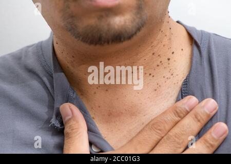 Closed up die Haut-Tags oder Acrochordon am Hals Mann auf weißem Hintergrund. Gesundheitskonzept Stockfoto