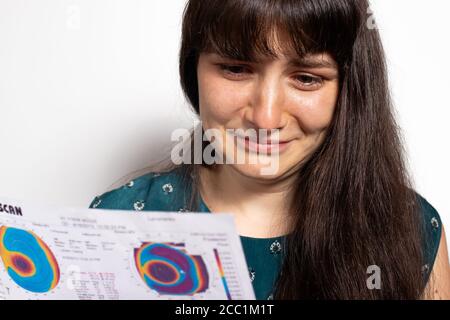 Dünner werdendes Hornhautdystrophie, Augen-Keratotopographie. Stockfoto