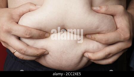 Die Hände des Menschen halten übergewichtigen Darm. Morbid Adipositas Konzept. Notwendigkeit für Ernährung Stockfoto