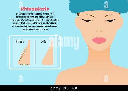 Rhinoplastik Vektor-Vorlage für Poster und BannerIllustration im flachen Stil Mit Beispieltext und weiblichem Porträt in Nahaufnahme bei Licht Blauer Hintergrund Stock Vektor