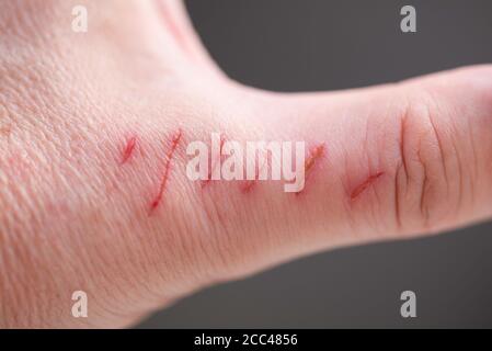 Finger mit parallelen Kratzern, viele Kratzer auf dunklem Hintergrund Stockfoto