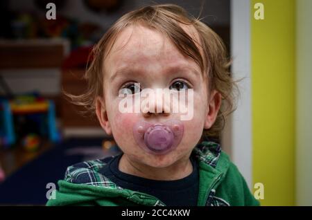 Kinder Viruskrankheit oder Allergien. Rote Masern Hautausschlag auf Baby. Kind mit viralen Kindern Krankheit Infektion. Konzept der viralen Baby-Krankheit und Impfungen Stockfoto