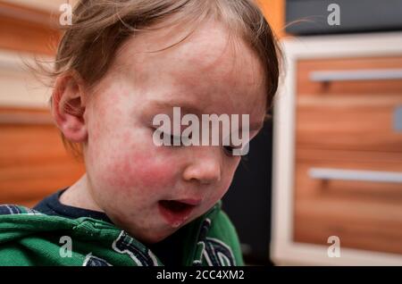 Kinder Viruskrankheit oder Allergien. Rote Masern Hautausschlag auf Baby. Kind mit viralen Kindern Krankheit Infektion. Konzept der viralen Baby-Krankheit und Impfungen Stockfoto