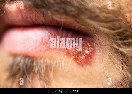 Nahaufnahme von Herpes auf den Lippen. Stockfoto