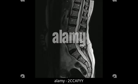 Magnetresonanzbilder der Lendenwirbelsäule sagittale T2-gewichtete Bilder (MRI Lendenwirbelsäule), die eine leichte Bandscheibenerkrankung zeigen. Stockfoto