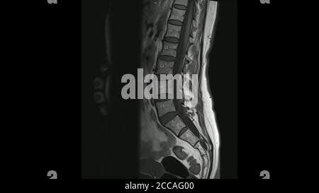 Magnetresonanzbilder der Lendenwirbelsäule sagittale T1-gewichtete Bilder (MRI Lendenwirbelsäule), die eine leichte Bandscheibenerkrankung zeigen. Stockfoto
