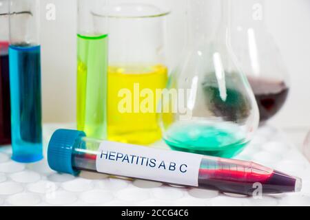 Proben des Hepatitis-Bluttests Stockfoto