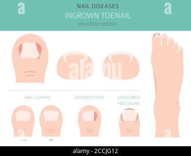 Nagelkrankheiten. Onychocryptosis, eingewachsene Zehennagel. Design medizinischer Infografik. Vektorgrafik Stock Vektor