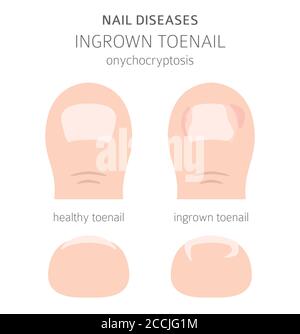 Nagelkrankheiten. Onychocryptosis, eingewachsene Zehennagel. Design medizinischer Infografik. Vektorgrafik Stock Vektor