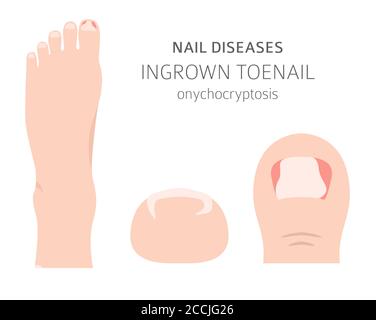 Nagelkrankheiten. Onychocryptosis, eingewachsene Zehennagel. Design medizinischer Infografik. Vektorgrafik Stock Vektor