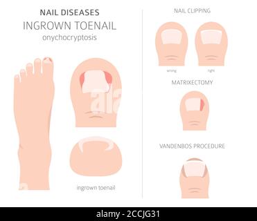 Nagelkrankheiten. Onychocryptosis, eingewachsene Zehennagel. Design medizinischer Infografik. Vektorgrafik Stock Vektor