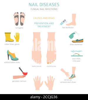 Nagelkrankheiten. Onychomykose, Nagel Pilzinfektion Ursachen, Behandlung Symbol gesetzt. Design medizinischer Infografik. Vektorgrafik Stock Vektor