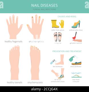 Nagelkrankheiten. Onychomykose, Nagel Pilzinfektion Ursachen, Behandlung Symbol gesetzt. Design medizinischer Infografik. Vektorgrafik Stock Vektor