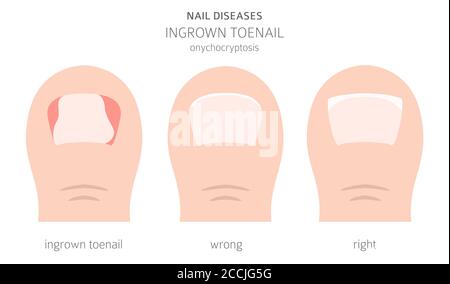 Nagelkrankheiten. Onychocryptosis, eingewachsene Zehennagel. Design medizinischer Infografik. Vektorgrafik Stock Vektor