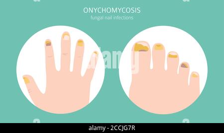 Nagelkrankheiten. Onychomykose, Nagel Pilzinfektion Ursachen, Behandlung Symbol gesetzt. Design medizinischer Infografik. Vektorgrafik Stock Vektor